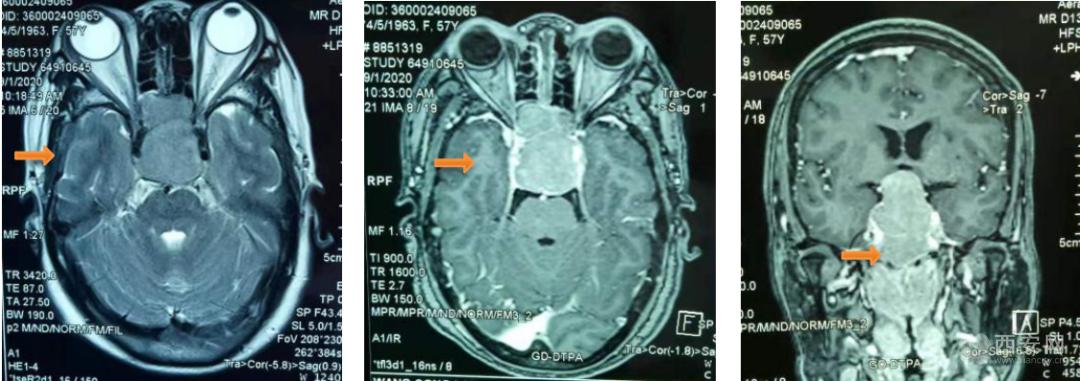 恶性脑瘤切除手术成功率,脑部肿瘤鼻腔微创手术