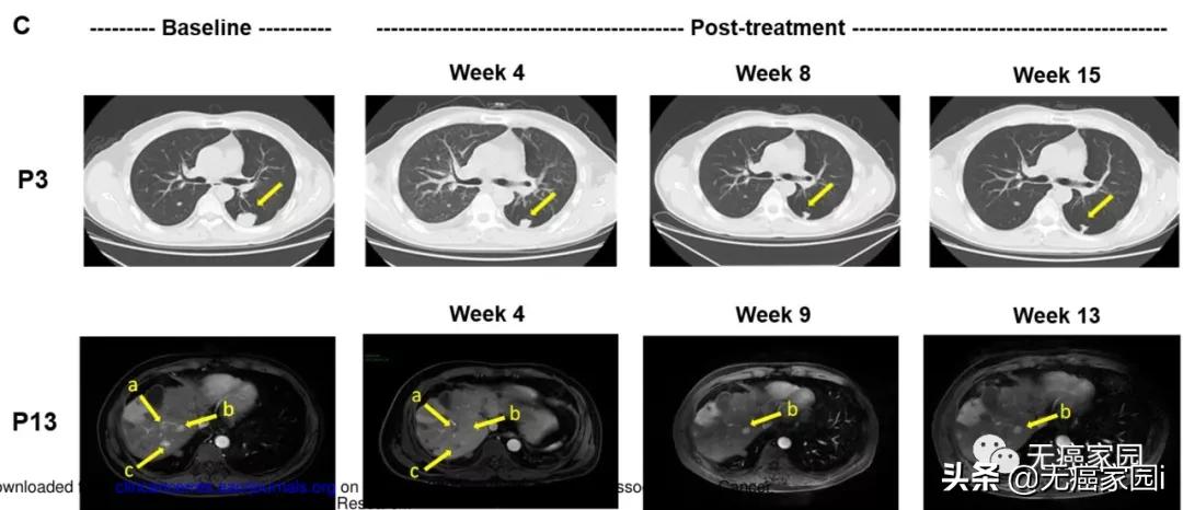 四川华西car-t疗法肝癌成功案例,全球首个car-t治疗晚期肝癌成果