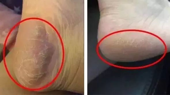 夏天了手脚干裂还有老茧,手脚干裂脱皮老茧用什么药膏