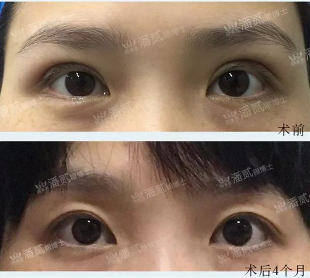 双眼皮凹陷眉毛怎么设计好看,凹眼窝适合什么眉型