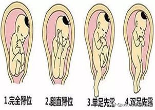 胎儿臀位,在孕多少周之前算是正常现象?巧用这3种方式扭转胎位