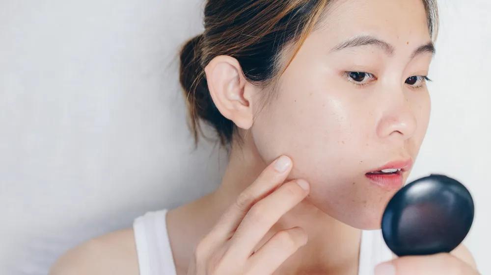 怎么祛痘印最好最快最有效,怎么祛痘印黑色素