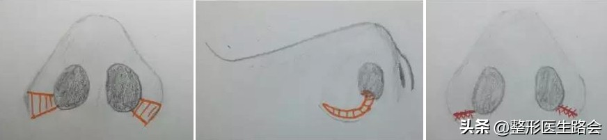 鼻翼缩小会有什么影响,鼻翼缩小会不会影响鼻子呼吸