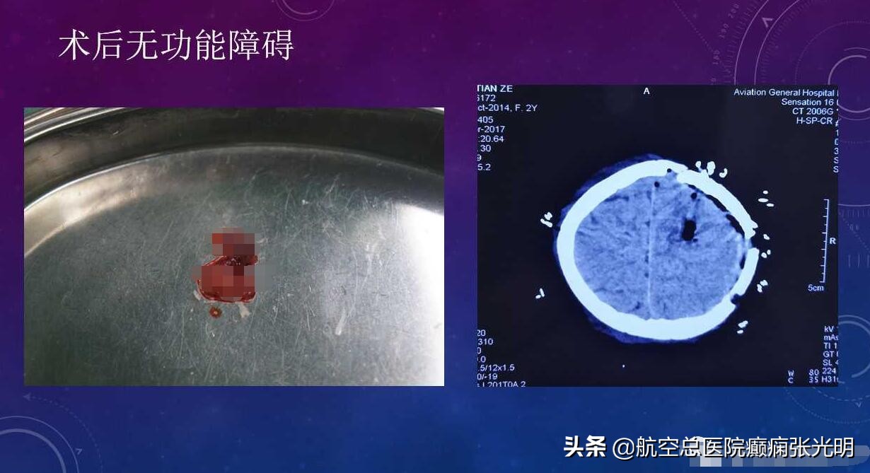 张光明左颞叶癫痫手术成功率,张光明谈治疗癫痫的方法有哪些