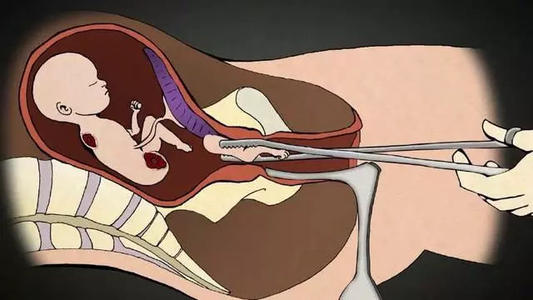 医生:劝君不要把人流当儿戏