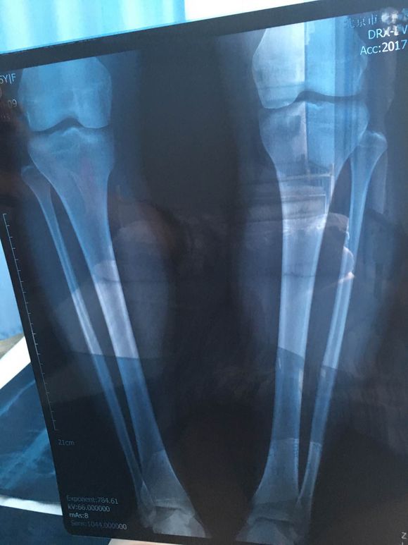 怎么从根本上解决o型腿,告别o型腿最快的方法