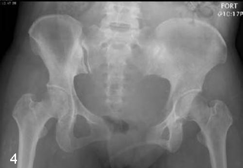 产前耻骨痛产后什么时候能恢复,产后20天突然耻骨痛是缺钙吗