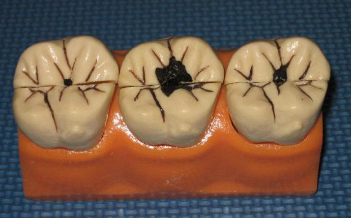 小孩蛀牙哭闹怎么办,儿童蛀牙了怎么处理一直哭