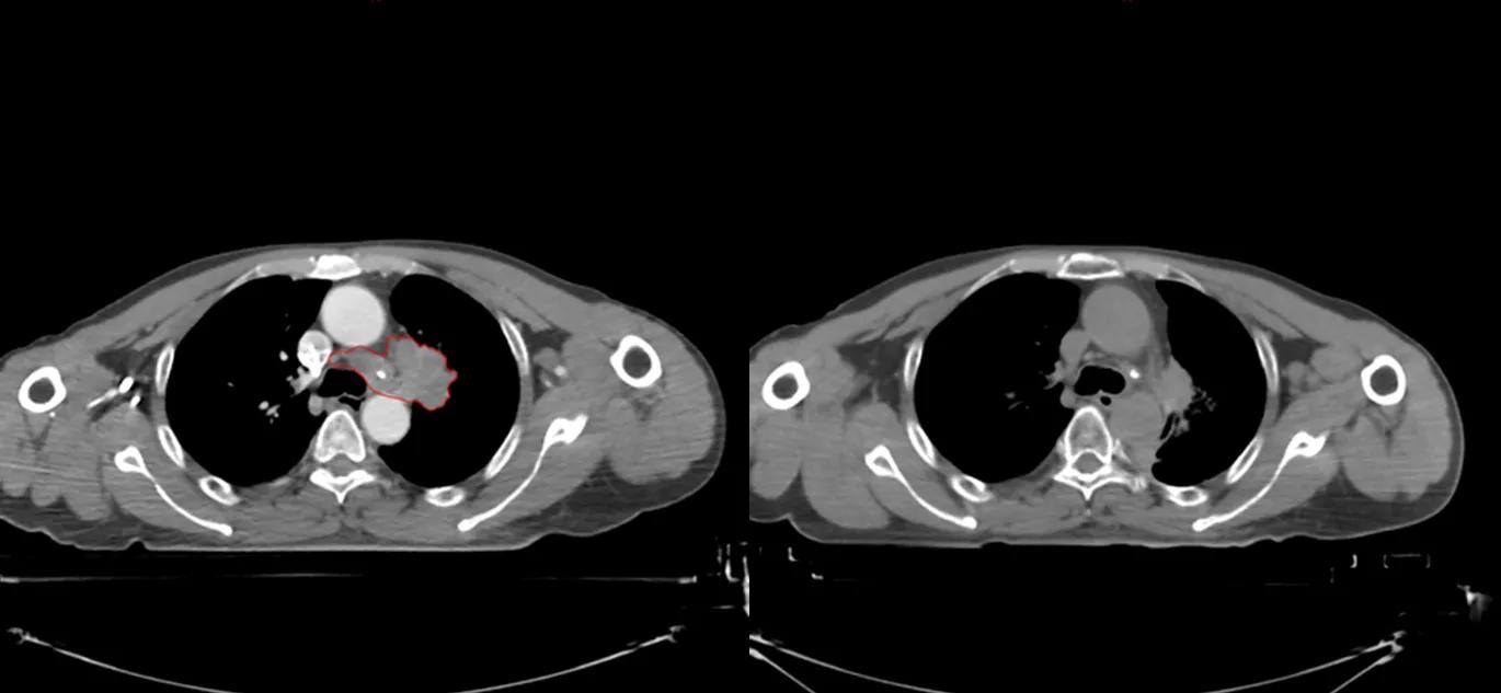 商陆治疗肺癌晚期,硼中子治疗晚期肺癌