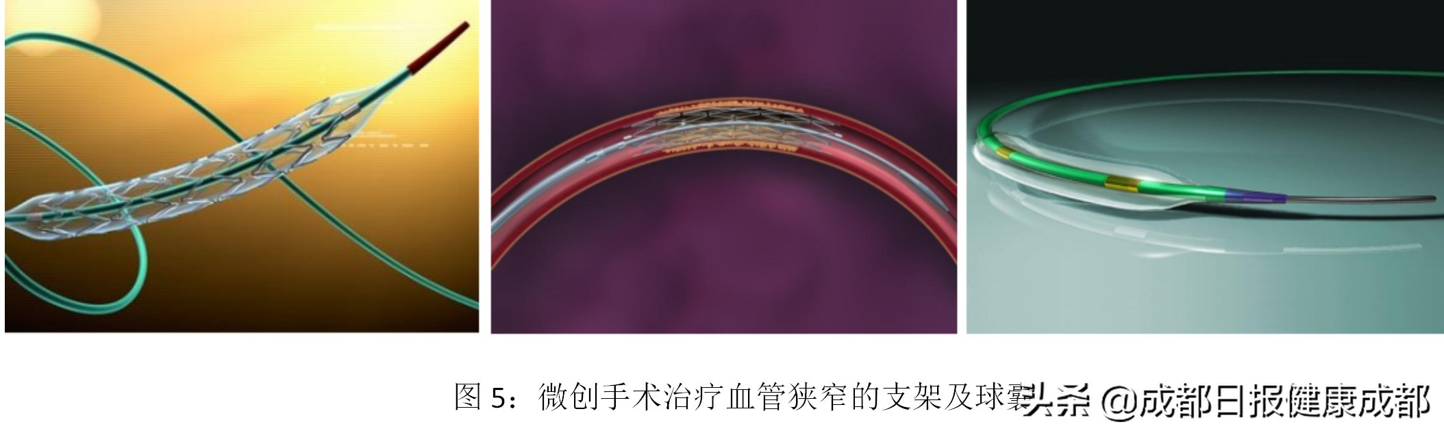 如何控制脑血管中风,脑血管堵了三根做搭桥还是支架