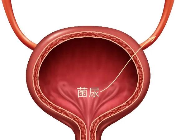 儿童尿频尿急怎么证明是尿路感染,什么原因导致小儿膀胱输尿管反流