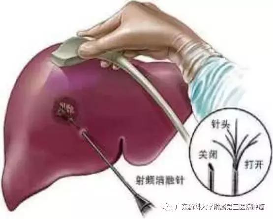 消融法治疗恶性肿瘤的疗效,消融术是消融良性还是恶性肿瘤