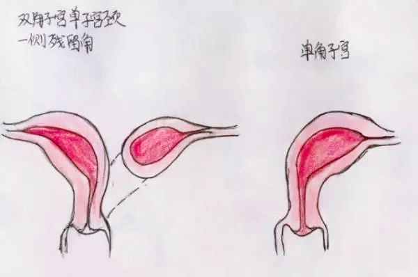 医生精美手绘图片大全,宫颈息肉红蓝铅笔手绘图