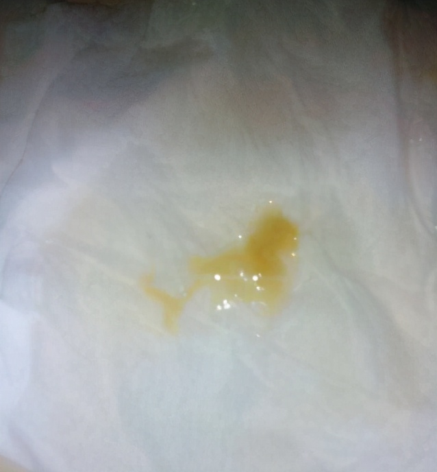 慢性支气管炎痰多药方,慢性气管炎气急咳黄痰中药方