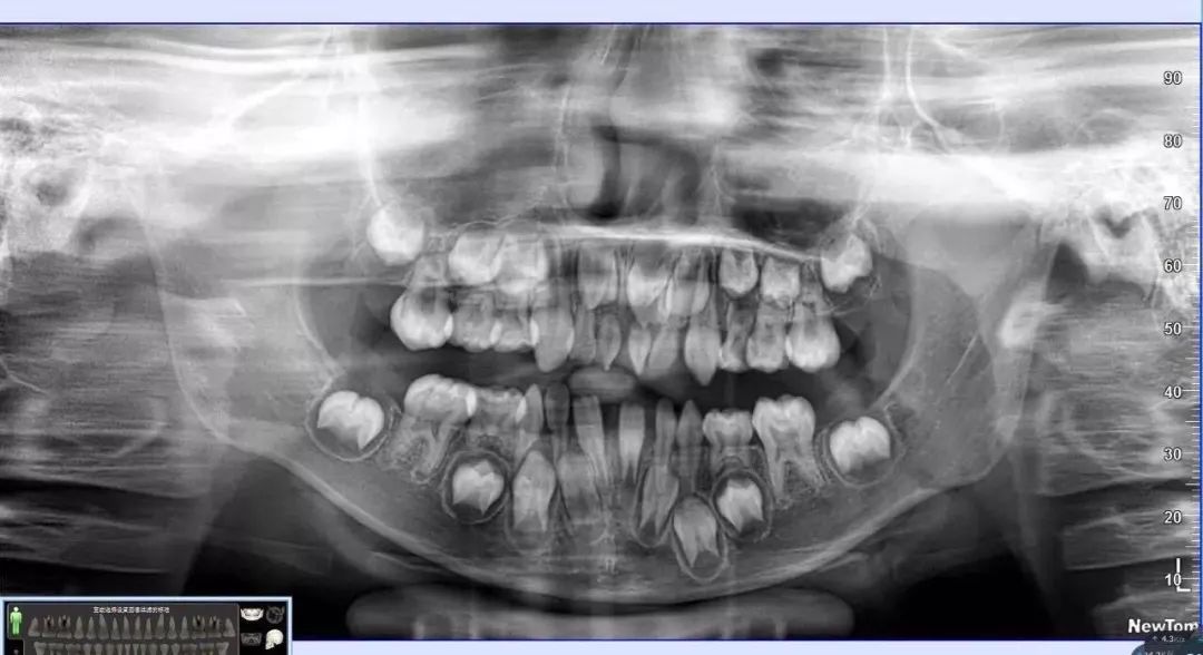 拍牙x光片对身体有什么危害,牙齿拍了几次x光片的危害