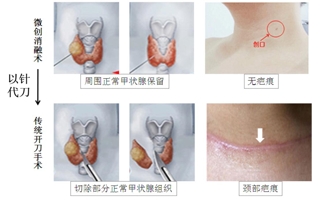 哈尔滨微创消融甲状腺结节哪家好,甲状腺结节微创消融术的过程