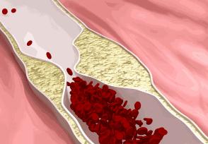 洗血疗法排毒方法视频讲解,三氧净血疗法视频