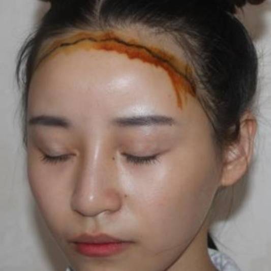 植发后取发区多久恢复正常,三级脱发植发能恢复到原来吗