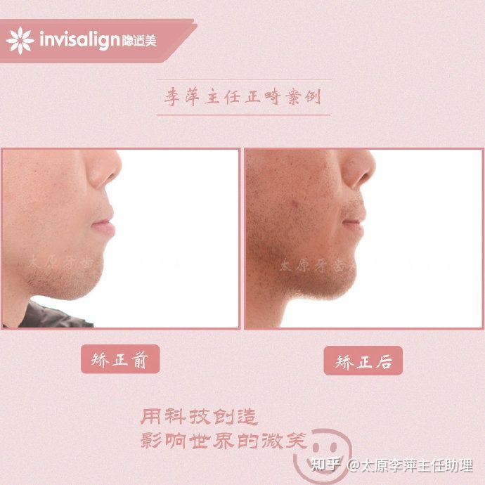 重度拥挤矫正牙齿适合隐形牙套吗,广州成人牙齿矫正推荐隐形牙套