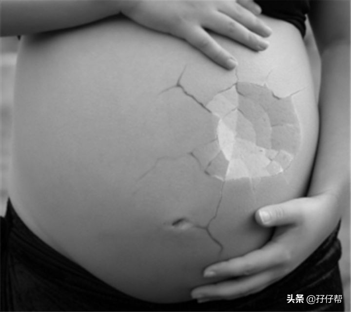 比青春还痛的是,怀上双胞胎的我长妊娠纹了