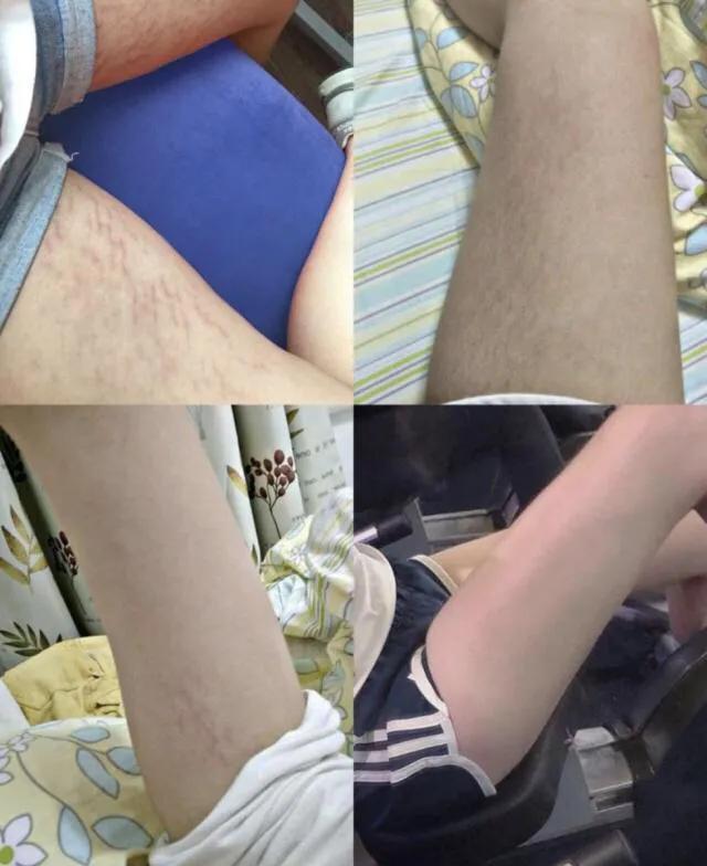 肥胖纹怎么消除吃什么保健,请问医生肥胖纹到底该如何去除