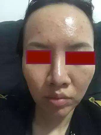 「许师解疑」难治性*疮痤**案析酸寒法