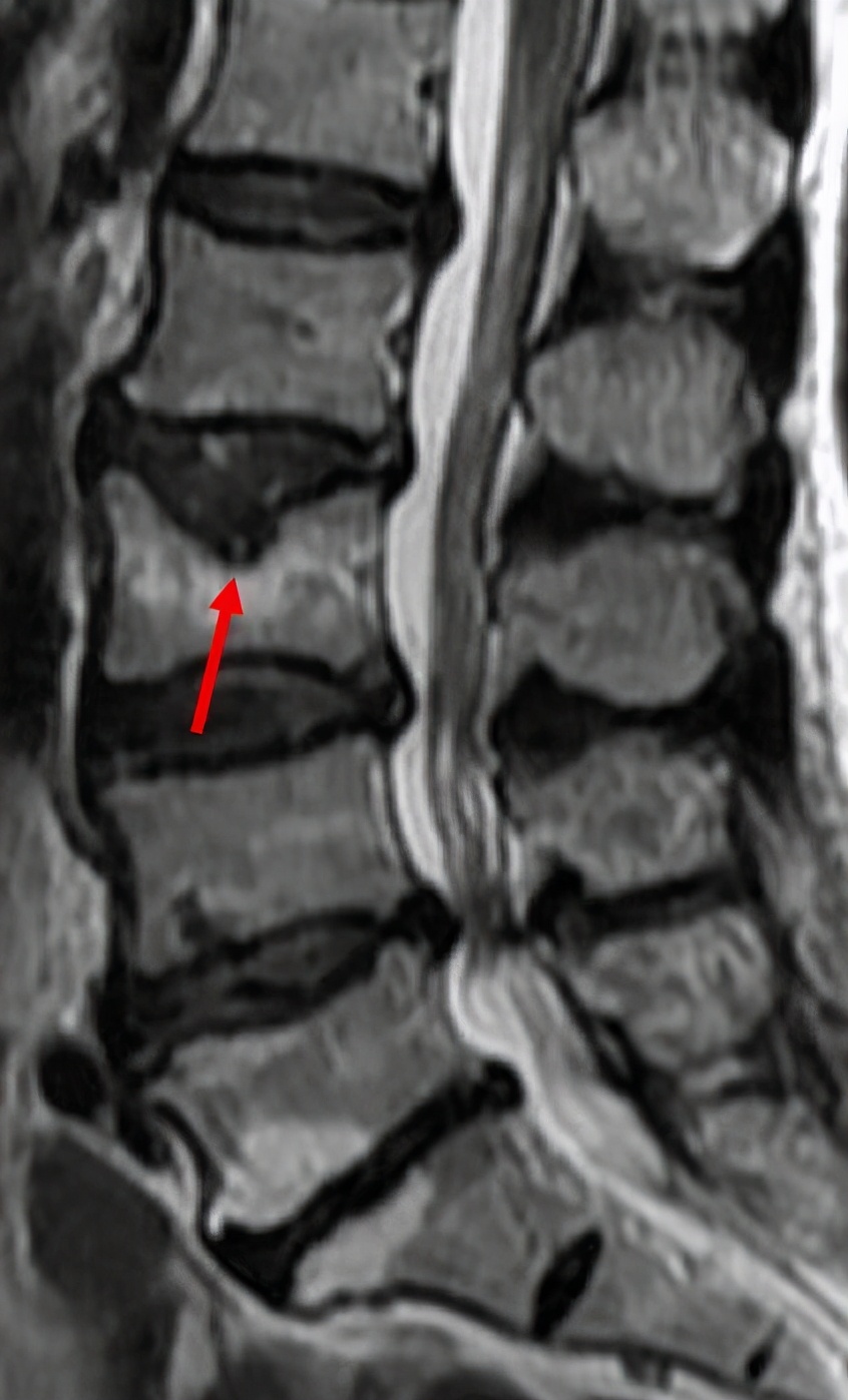 腰椎增生和腰间盘突出哪个更严重,腰椎间盘突出3毫米5毫米严重吗