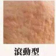 比激光更有效的祛痘坑方法,痘痘痘坑怎么消除