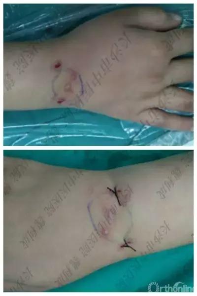 腱鞘囊肿除了手术还有什么办法,下颚有囊肿可以做穿刺手术