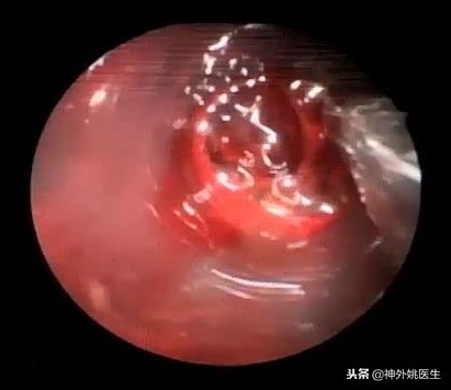 球囊扩张血肿怎么办,神经内镜辅助脑内血肿清除