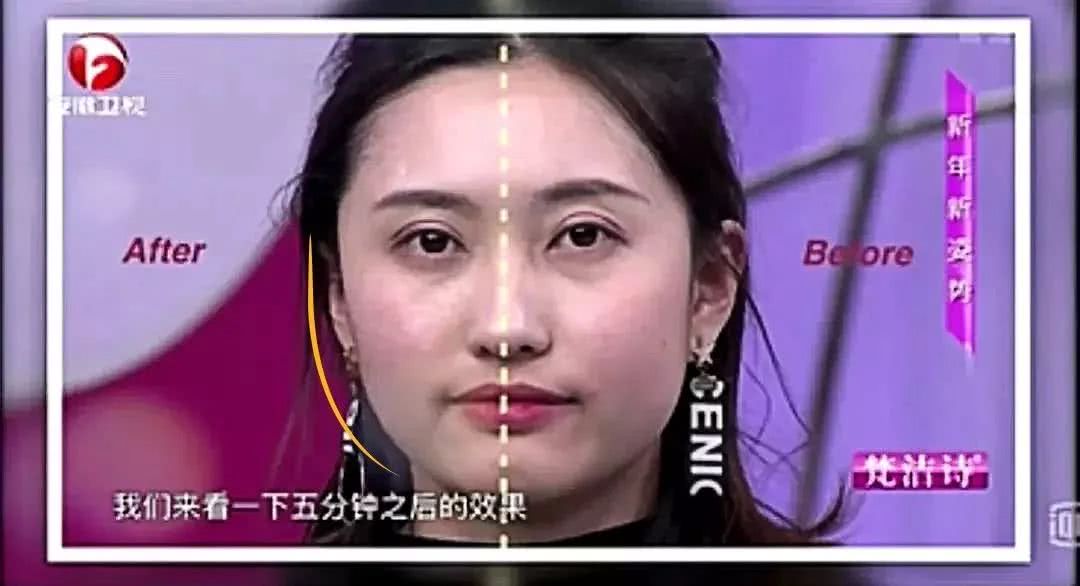 微整的真实效果,微整蜕变过程