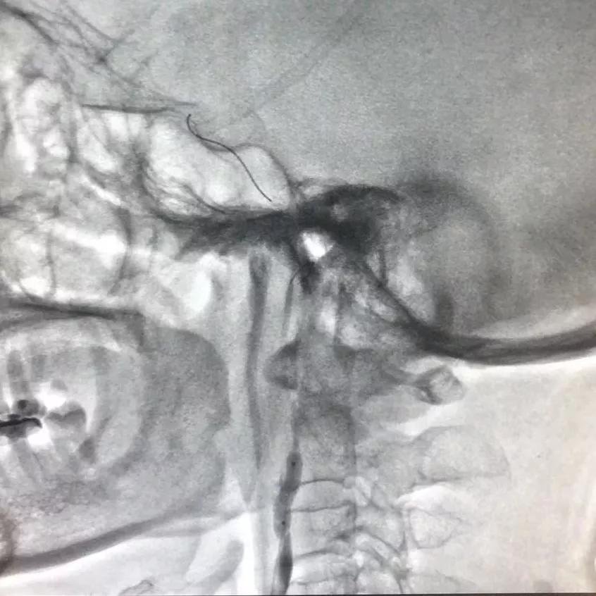 颅内覆膜支架应用于肿瘤侵袭性颈内动脉治疗