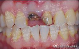 现在修复牙齿有哪几种类型的牙,牙齿修复的几种方法和价格