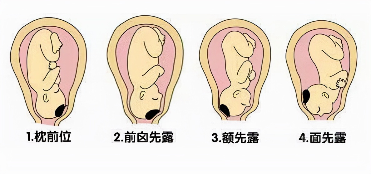 孕妇胎位不正要怎么调整最好,一般孕妇胎位不正怎么纠正效果好