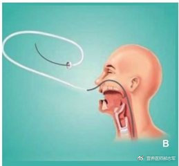 肠内营养并发症的处理ppt,肠内营养的禁忌有哪些