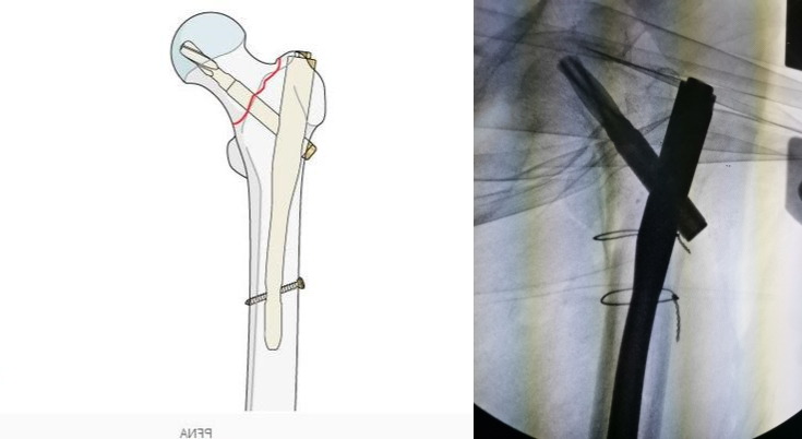 老人一屁股摔倒脊柱骨折如何治疗,老人一屁股坐地上怎么处理