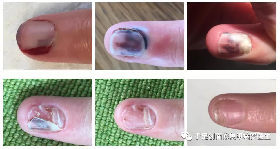 甲下积血怎么处理,甲下积血不排血会胀痛吗