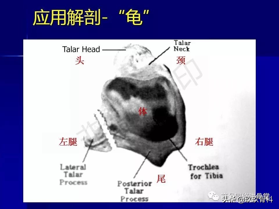 距骨骨折后遗症,距骨骨折怎么办