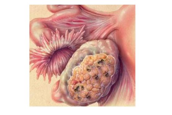 大妈肚子疼一周未重视，检查发现已是卵巢晚期