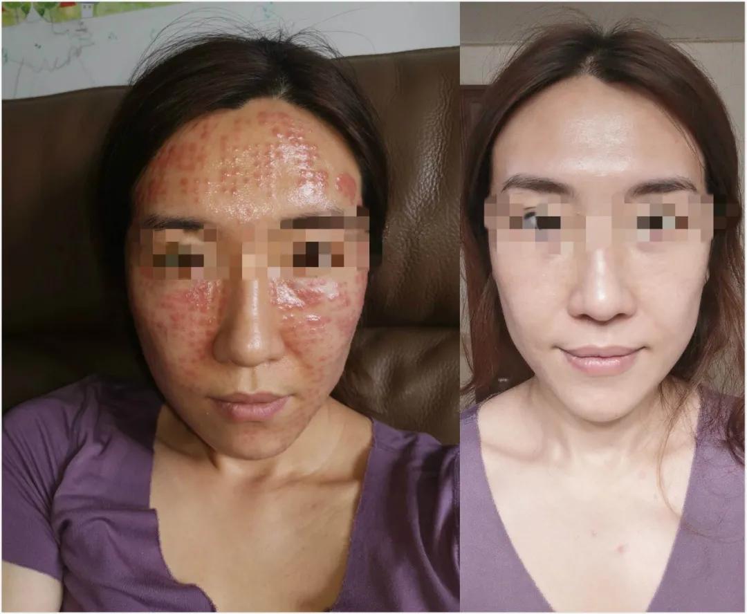 一次水光针需要2000多针吗,一次水光针等于100片面膜