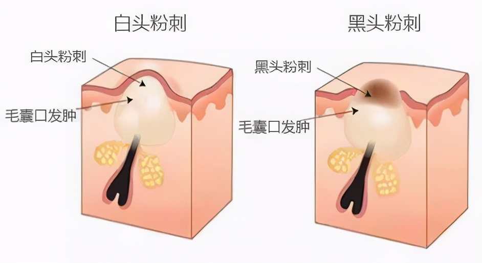 被黑头粉刺挤出来的痘痘怎么办,被粉刺闭口困扰怎么办