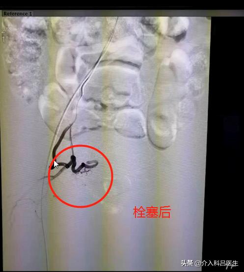 她因不堪子宫腺肌症折磨，专程从国外飞回来，接受这项微创疗法
