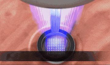 超皮秒激光祛斑真的有效果吗,超皮秒祛斑效果