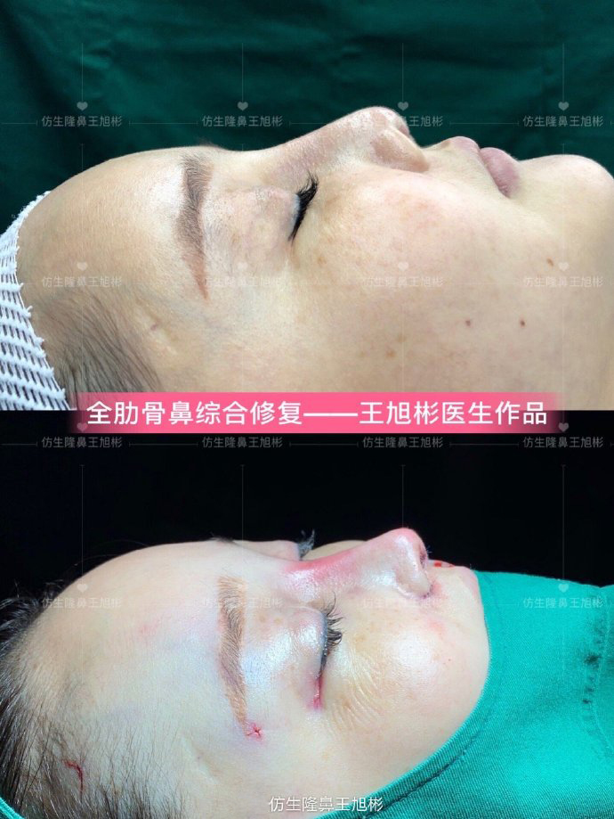 骨粉注射隆鼻皮肤变薄怎么办,线雕隆鼻会引起鼻挛缩吗
