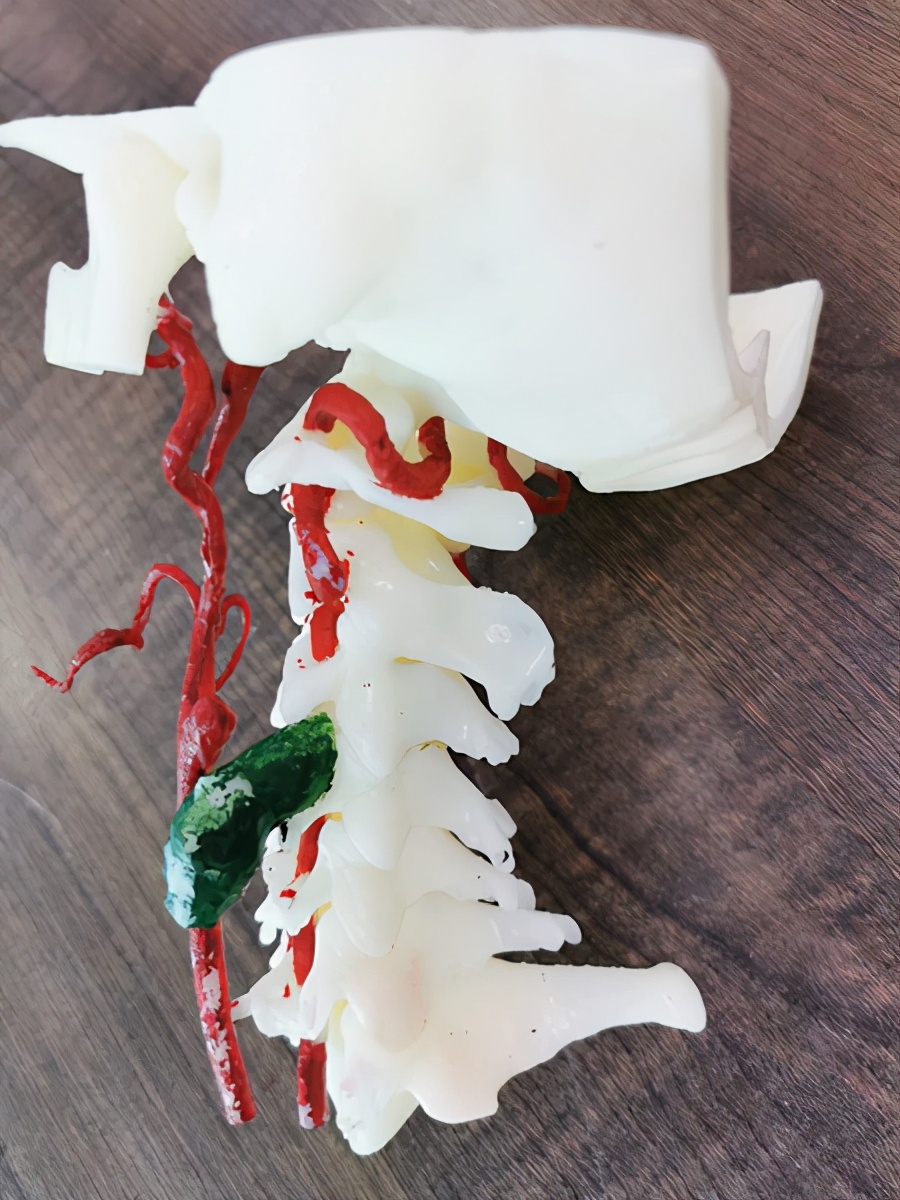 3d打印治疗脊柱肿瘤费用,颈椎3d打印手术要多少钱