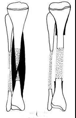 中国有没有断骨增高手术,什么是断骨增高手术