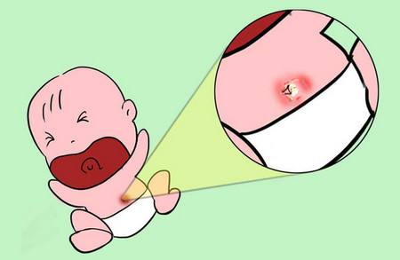 新生儿脐带可以涂抹消炎药吗,新生儿脐带感染是怎么回事