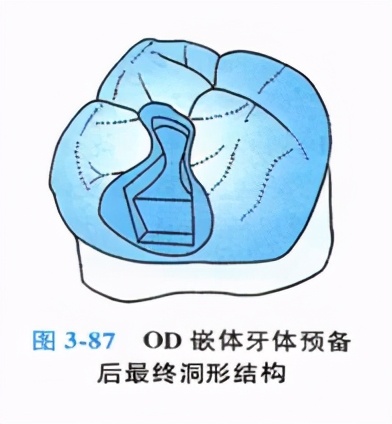 牙科嵌体的处理,牙科医生讲义