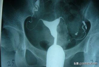 青岛助孕专家于萍:输卵管造影,常见问题解答