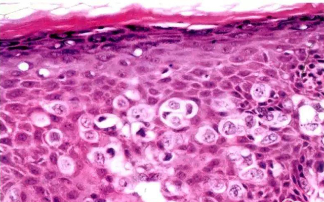 过敏性紫癜属于风湿免疫性疾病吗,过敏性紫癜肾炎是自限性疾病吗